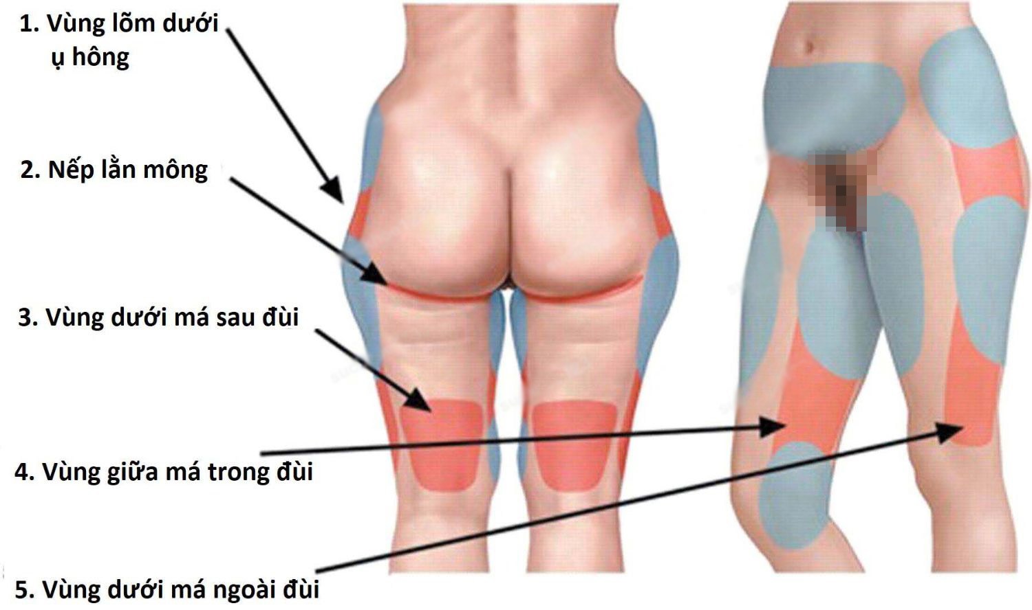 Ở đùi, mỡ không phân bổ đồng đều. Có những vị trí dễ tích tụ mỡ, tạo thành những ụ mỡ xấu xí. Vùng màu đỏ là nơi ít mỡ, vùng màu xanh là nơi nhiều mỡ thường được chỉ định hút mỡ.