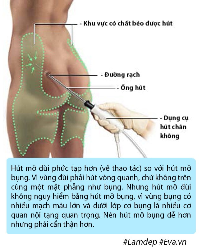 amp;#34;Bom sexamp;#34; Anh phải nằm ngửa, treo 2 chân lên cao trong nhiều ngày vì phù nề sau hút mỡ - 5