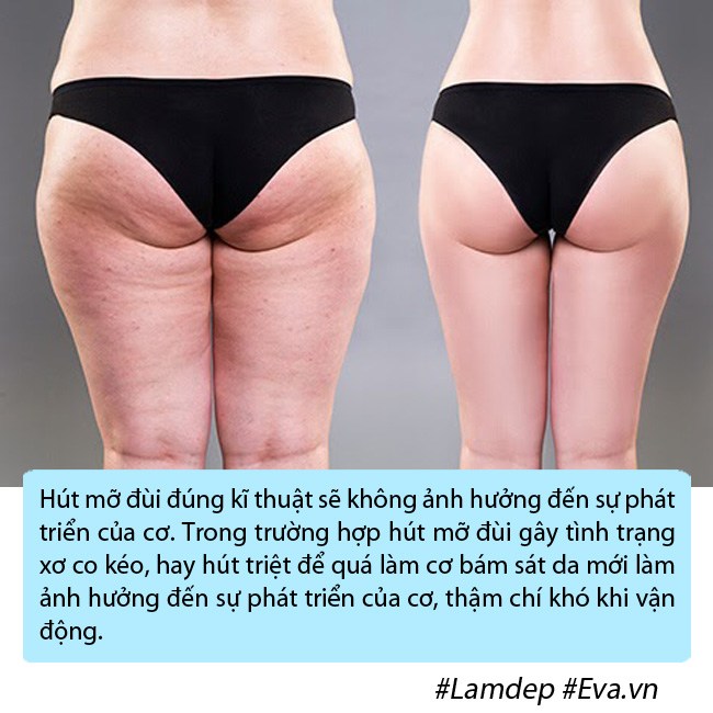 amp;#34;Bom sexamp;#34; Anh phải nằm ngửa, treo 2 chân lên cao trong nhiều ngày vì phù nề sau hút mỡ - 6
