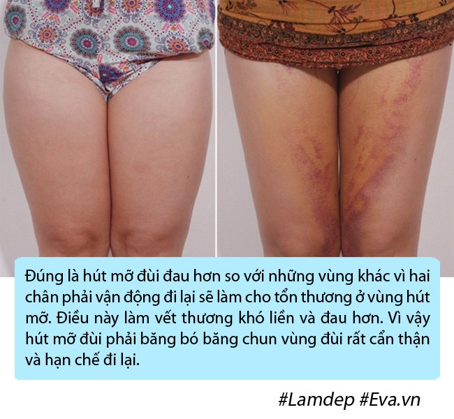 amp;#34;Bom sexamp;#34; Anh phải nằm ngửa, treo 2 chân lên cao trong nhiều ngày vì phù nề sau hút mỡ - 7