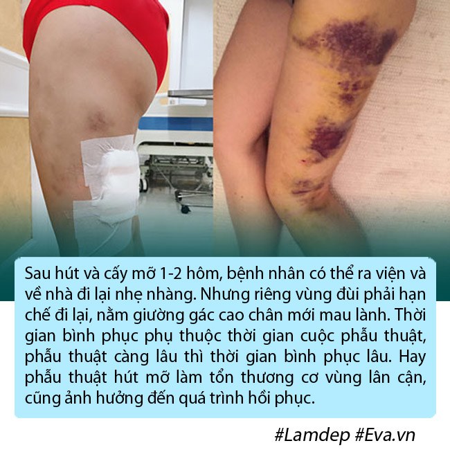 amp;#34;Bom sexamp;#34; Anh phải nằm ngửa, treo 2 chân lên cao trong nhiều ngày vì phù nề sau hút mỡ - 9