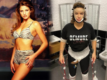 Bom sex Anh phải nằm ngửa, treo 2 chân lên cao trong nhiều ngày vì phù nề sau hút mỡ