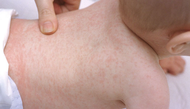 Nổi mẩn đỏ, ngứa là dấu hiệu của các bệnh lý thường gặp ở trẻ (Ảnh minh họa)