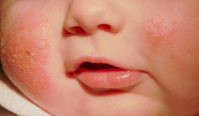 Không nên chủ quan với nấm da ở trẻ em (Ảnh minh họa)