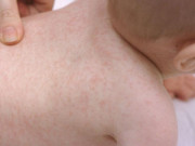 Làm mẹ - Bé bị nổi mẩn đỏ khắp người và ngứa là bị làm sao, xử lý thế nào?