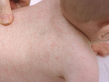 Bé bị nổi mẩn đỏ khắp người và ngứa là bị làm sao, xử lý thế nào?