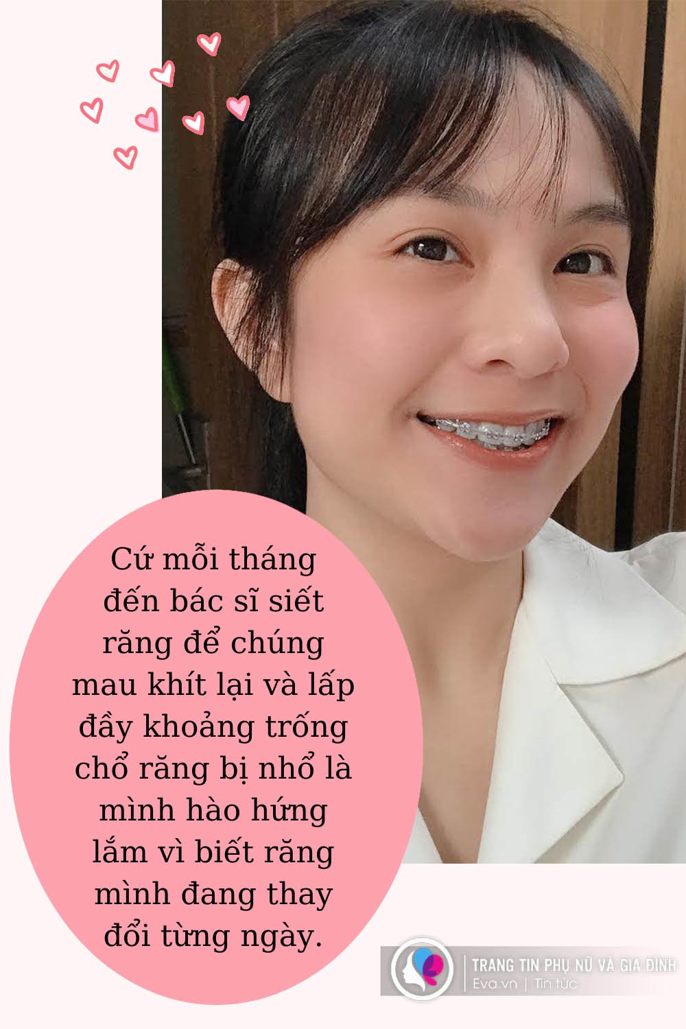 Cô gái amp;#34;dằn mặtamp;#34; người yêu cũ khi gỡ bỏ 8 chiếc răng, từ vịt hoá thiên nga - 6