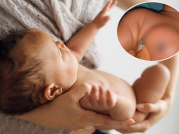 Kỳ lạ: Bé trai 1 tuần tuổi ngực đột nhiên to ra như thiếu nữ, thậm chí còn tiết sữa