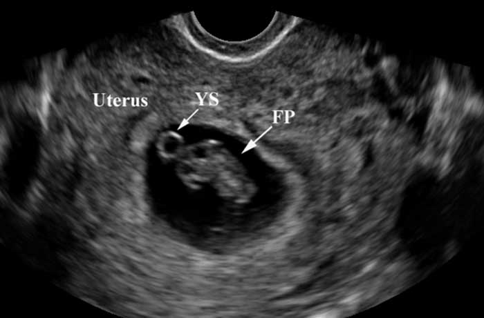 Hình ảnh siêu âm túi noãn hoàng. (Ảnh minh họa)