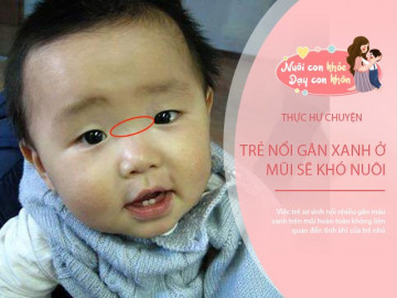 Thực hư chuyện trẻ nổi gân xanh ở mũi sẽ khó nuôi, khoa học giải thích