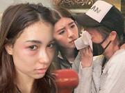 Làm đẹp - Biến chứng thẩm mỹ, đến Hoa hậu cũng không thoát khỏi