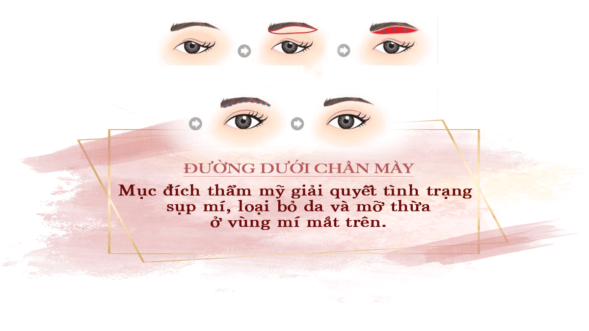 Treo cung chân mày là gì mà ai làm cũng trẻ ra chục tuổi? - 3