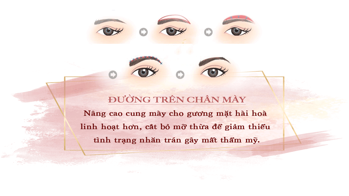 Treo cung chân mày là gì mà ai làm cũng trẻ ra chục tuổi? - 4