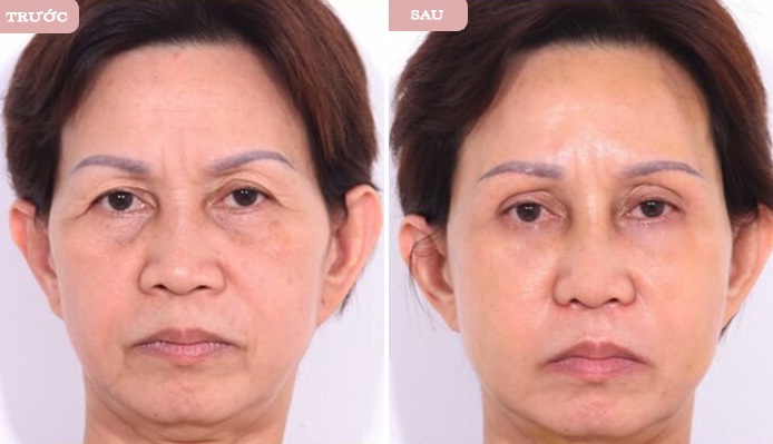 Treo cung chân mày được nhiều chị em tin tưởng vì có thể giúp họ trẻ ra cả chục tuổi. 