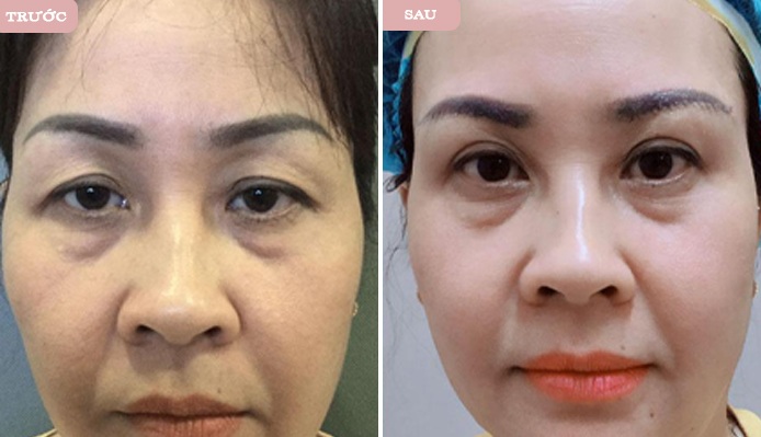Các vấn đề như mí bị sụp xuống làm che mất một phần nếp mí, mắt lờ đờ mệt mỏi, vùng da quanh mắt nhăn nheo cũng được xử lý.