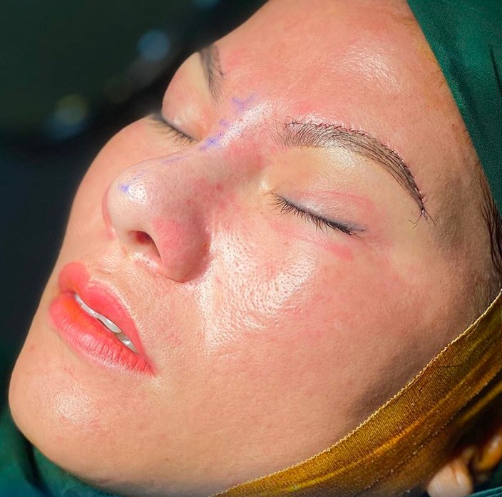 Treo cung chân mày bằng đường rạch ở phía trên sát với đường chân mày và được khâu lại bằng đường khâu mảnh, thẩm mỹ, giúp giấu sẹo tốt.