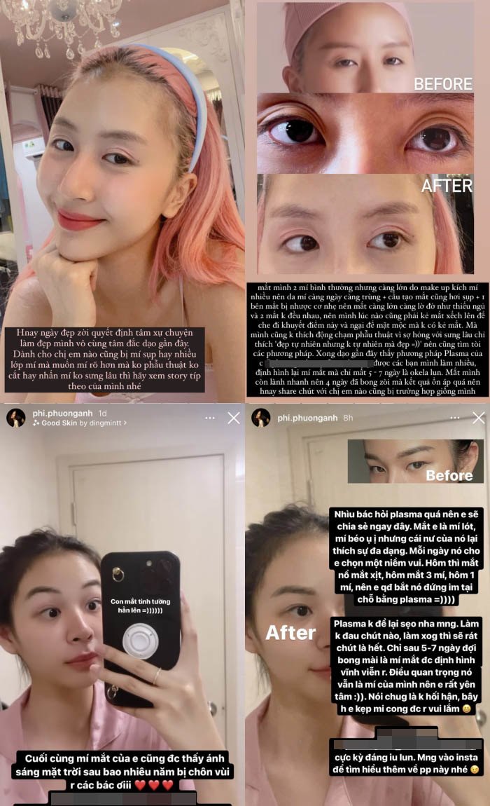 Ngoài Hiền Hồ còn có Quỳnh Anh Shyn hay Phí Phương Anh cũng từng lên tiếng ngợi ca biện pháp nâng cơ mí không phẫu thuật này cho đôi mắt 2 mí to rõ ràng.