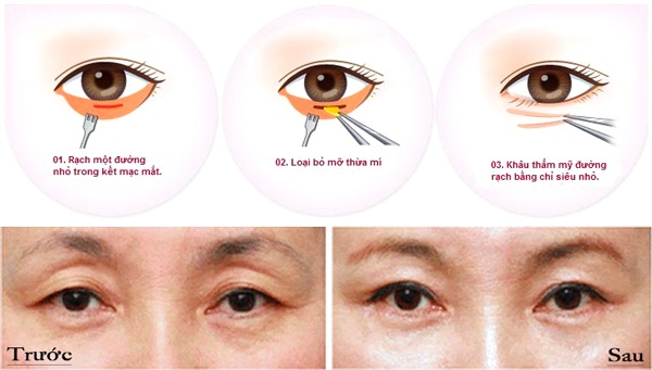 Lấy mỡ bọng mắt cũng góp phần làm cho gương mặt trẻ hơn, lanh lợi hơn và phần nào giảm nếp nhăn trong trường hợp được xử lý da thừa.