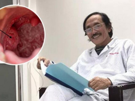 Căn bệnh nghệ sĩ Giang Còi mắc thường phát hiện muộn: Người bị nuốt nghẹn, khàn tiếng đừng chủ quan