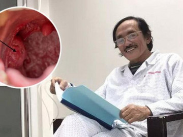 Căn bệnh nghệ sĩ Giang Còi mắc thường phát hiện muộn: Người bị nuốt nghẹn, khàn tiếng đừng chủ quan