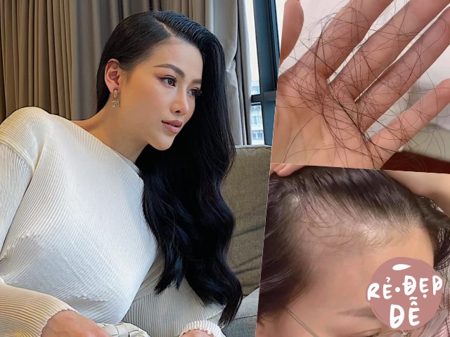 Rẻ-Đẹp-Dễ: Hoa hậu Phương Khánh tóc rụng cả mảng, nhìn công đoạn chữa hói mới không ai ngờ