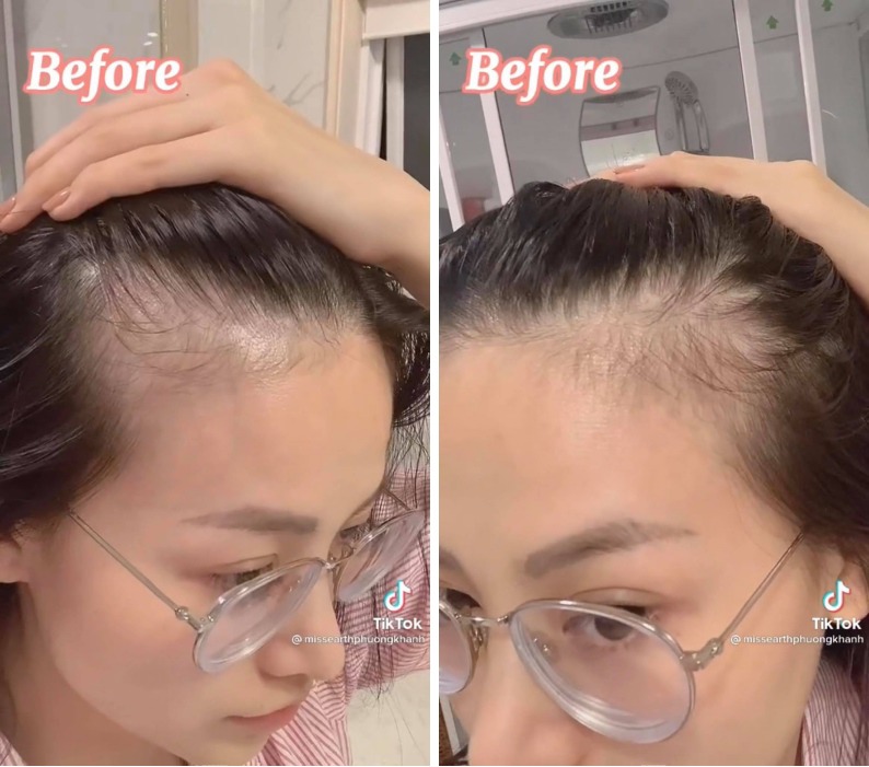 Rẻ-Đẹp-Dễ: Hoa hậu Phương Khánh tóc rụng cả mảng, nhìn công đoạn chữa hói mới không ai ngờ - 5