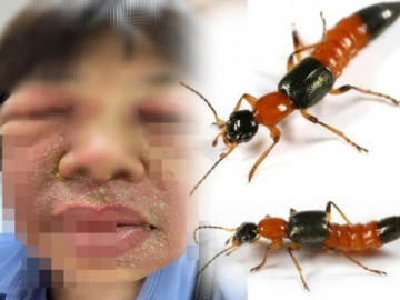 Bị kiến ba khoang đốt, tuyệt đối tránh làm việc này nếu không muốn người lở loét, mặt nở hoa