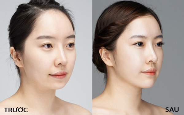 Filler và Botox đều là kỹ thuật làm đẹp được nhiều chị em lựa chọn. Nhưng ai nên làm cách nào hoặc phối hợp ra sao, cần được bác sĩ thăm khám và tư vấn phương pháp phù hợp nhất, không nên tự ý sử dụng tránh gây nguy hiểm và biến chứng.