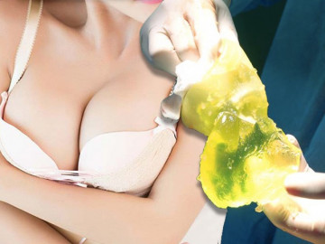 Thắc mắc lớn: Nâng ngực 1 thời gian có bị nhỏ đi không và bao lâu phải sửa sang lại?