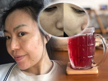 Trị nám tại nhà giúp da sáng khỏe với giá chỉ 3k