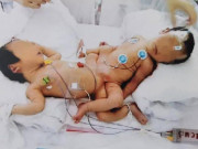 Bà bầu - Cô gái chào đời dính liền phần dưới với chị, 20 năm sau "choáng váng" nhận tin có bầu