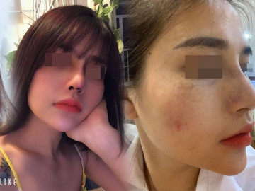 Hành trình làm đẹp 5 năm xót ví của mẹ 2 con: thủng mũi, áp-xe má, đau nhất chữa nám