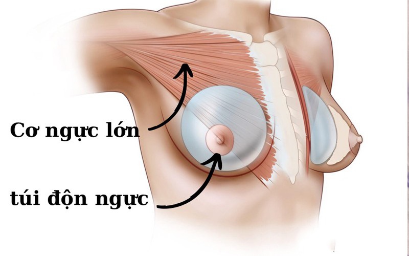 Túi ngực được đặt dưới cơ ngực lớn để đảm bảo không ảnh hưởng đến hệ thống tuyến sữa.