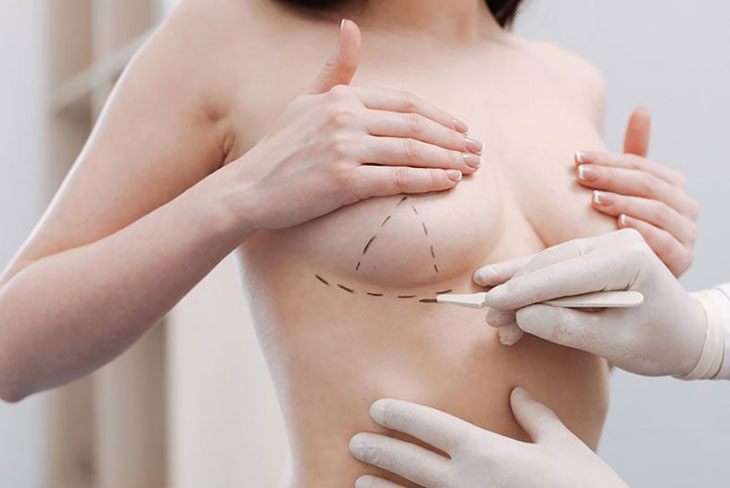 Nâng ngực được xem là ca đại phẫu nên cần kỹ lưỡng trong việc chọn bác sĩ và cơ sở uy tín để tránh để lại biến chứng đáng tiếc.
