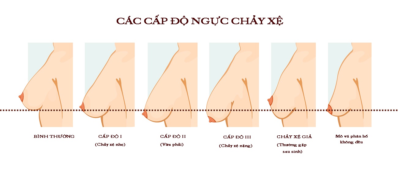 Các cấp độ ngực chảy xệ sau sinh.