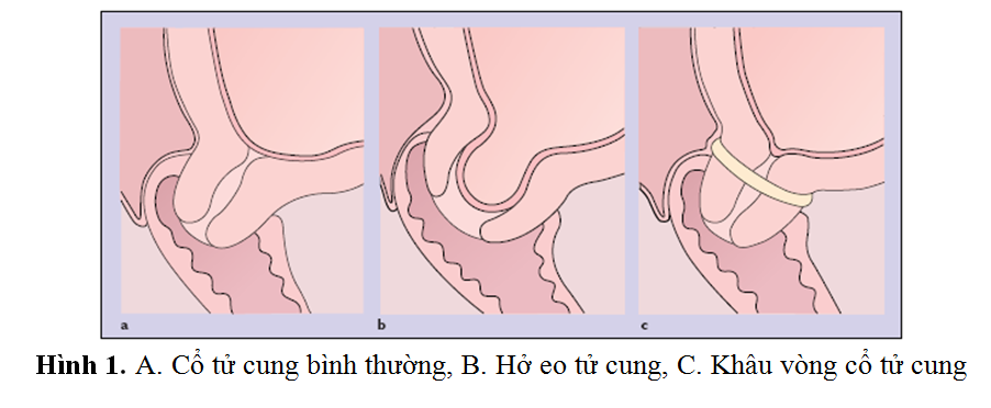 Thấy amp;#34;có gì đó lạamp;#34; ở  vùng nhạy cảm, mẹ bầu Hà Nội đau đớn mất con 20 tuần - 4