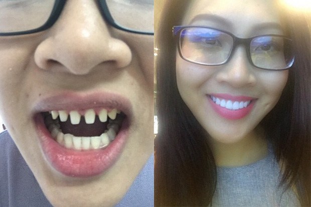 Hoa khôi Áo dài 2016 Diệu Ngọc cũng từng lộ ảnh mài răng trước khi bọc sứ.