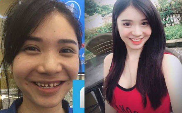 Đã thẩm mỹ răng chắc hẳn không ai muốn tháo ra làm gì, tháo ra mà có hàm răng như của Thanh Bi thà ngay từ đầu không làm còn hơn.