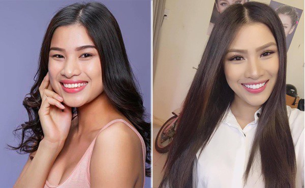 Nguyễn Thị Thành trước và sau khi có điều chỉnh hàm răng của mình. Cô cho biết không hối hận vì đã làm răng nhưng rất buồn vì vụt mất cơ hội.