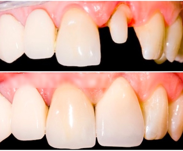 Hình ảnh mô tả hình thức bọc răng sứ thẩm mỹ, phần răng thật sau khi đã mài chỉ cao khoảng 1 nửa và nhỏ bằng 1/3 răng thật mà thôi. Có lẽ không ai muốn trở lại hình ảnh này, nhất là một người đẹp. Và thực có tháo răng sứ ra đi nữa, nụ cười thế này của cô cũng sẽ không có cơ hội tại những cuộc thi sắc đẹp.