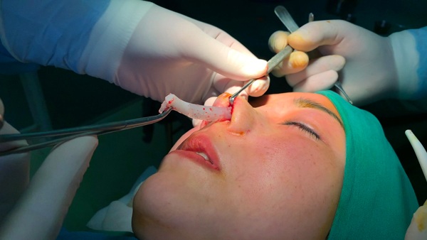 Theo các bác sĩ chuyên gia thẩm mỹ, tháo sụn mũi là kỹ thuật đơn giản, sau khi tháo sụn dáng mũi vẫn sẽ được trở lại trạng thái gần như bình thường trước đây.