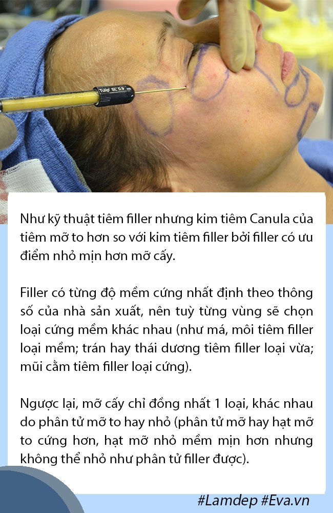 Cấy mỡ tự thân: Lấy mỡ vùng nào giữ lâu nhất, filler liệu có cửa? - 2