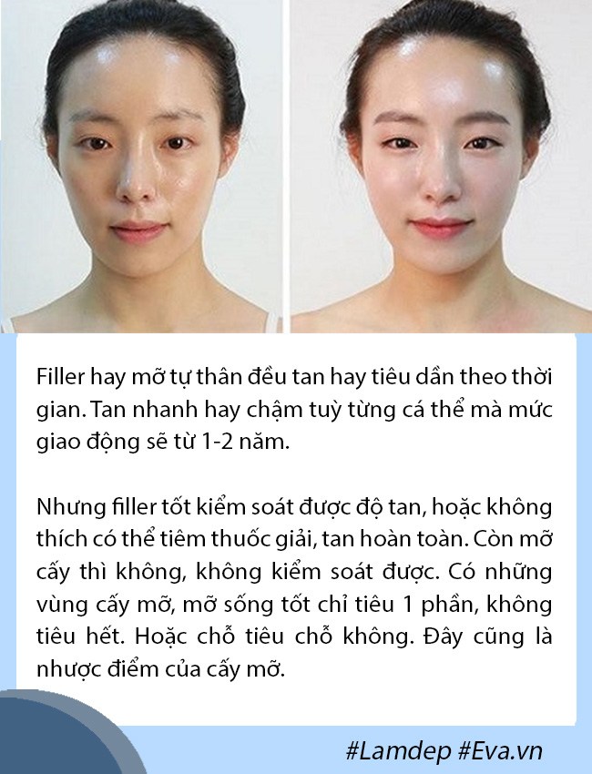 Cấy mỡ tự thân: Lấy mỡ vùng nào giữ lâu nhất, filler liệu có cửa? - 3