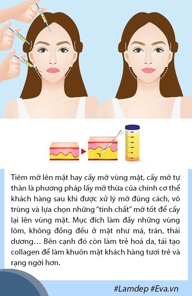 Cấy mỡ tự thân: Lấy mỡ vùng nào giữ lâu nhất, filler liệu có cửa? - 1