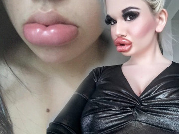 Tâm linh không dám đi cắt môi, gái xinh mạnh dạn tiêm filler nhận ngay đôi môi thảm họa