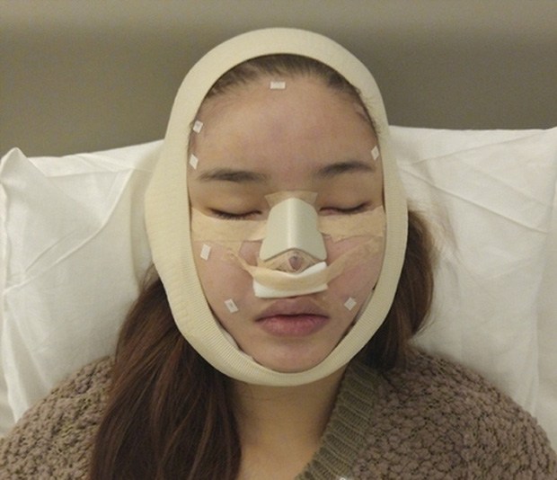 Dù thay đổi rất nhiều song cô cũng không ngần ngại khẳng định có dao kéo, Kỳ Hân còn công khai cả hình ảnh vừa mới phẫu thuật xong với gương mặt được băng bít của mình.