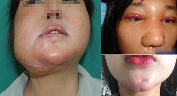 Sưng phù kéo dài cộng với nhiều dấu hiệu bất bình thường khác nữa có thể bạn đã gặp biến chứng thẩm mỹ.