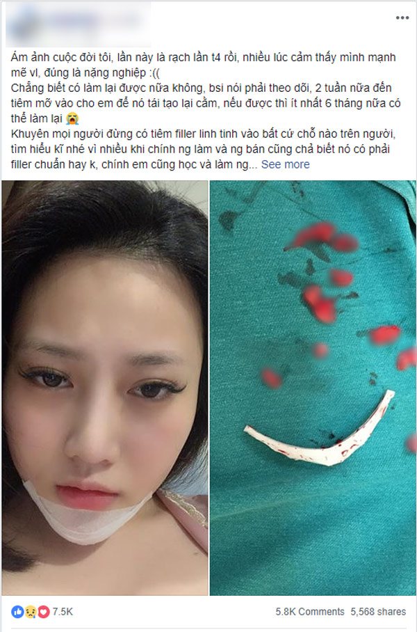 9x Hà Nội chia sẻ ám ảnh do gặp biến chứng sau khi gặp biến chứng độn cằm và tiêm filler.
