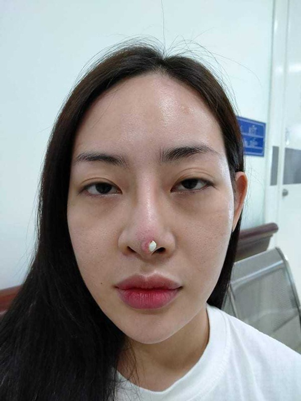 Không chỉ sưng đau, da có thể bị chọc thủng, nhiều trường hợp còn bị ảnh hưởng nặng tề tới các cơ quan khác như ảnh hưởng tới mắt, nhiễm trùng máu...