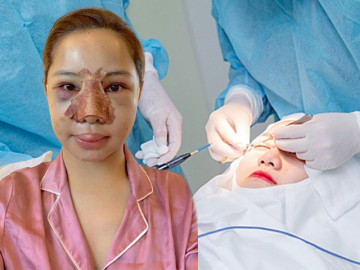 Tại sao gương mặt thường phù lên sau phẫu thuật thẩm mỹ, có nguy hiểm không?